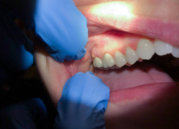 Best Emergency Gum Treatment in Havana, FL